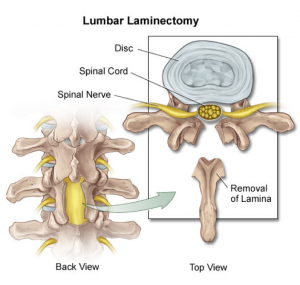 Lumbar laminectomy for the decompression of the nerve roots in the spinal canal.