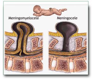 Image: Spinal meningocele