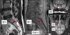 Spine MRI. Red arrows show Tarlov cyst in the spinal canal.