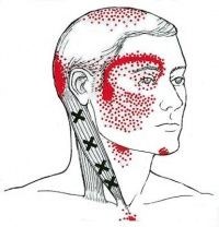 Irradiation of the pain at occipital neuralgia