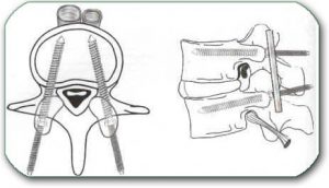 Figure: Stabilization of the lumbar vertebrae with screws that are screwed into the vertebrae and connected with metal rods. This prevents further movement of the vertebrae, relative to each other, and they can return to their normal position.