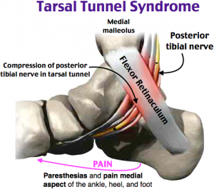 Figure: Tarsal Tunnel Syndrome