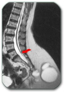 Figure: Tethered cord syndrome in which the end of the spinal cord is pulled to the level of the L5 vertebra (red arrow). Normally this end is at the level of the L1 or L2 vertebrae.