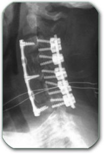 Figure: The X-ray shows the stabilization of the cervical spine from the front and from the back.