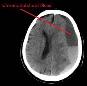 Figure: The arrow shows a chronic subdural hematoma compressing the brain