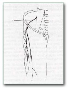 Figure: 1- The lateral femoral cutaneous nerve is most often pressed when it passes under the inguinal ligament and enters the thigh.