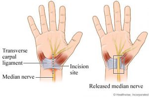 Figure: The median nerve underneath the transverse ligament. The line shows a small incision in the skin and transverse ligament that relieves pressure on the nerve. During the operation, it is important to be careful with the branches of this nerve and recognize whether there are changes in the nerve that also need to be operated on.