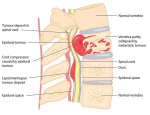 Image: Thoracic spine vertebral tumor that led to bone weakening and, subsequently, vertebral body collapse (compressive pathological fracture)