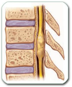 Image: Tumor within the spinal cord