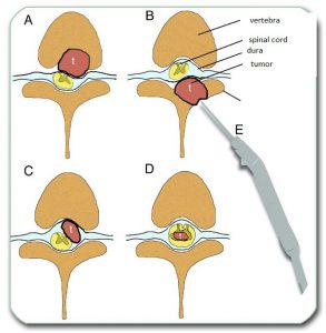 Figure: A. Tumors growing from the vertebral body; B. Tumors growing from the posterior parts of the vertebrae; C. Tumors growing inside the dural membrane but outside the spinal cord; D. Tumors growing inside the spinal cord. E. Cusa - a device that removes tumors.