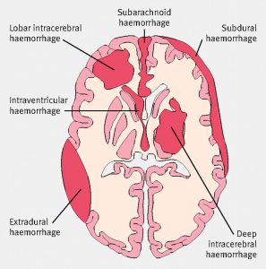 Image: Types of hematomas. An epidural hematoma is a blood clot between the skull bone and the dura mater (brain covering fibrous sheet); a subdural hematoma is a clot between the meninges and the brain; an intracerebral hematoma is a clot inside the brain.