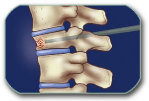 Image: Vertebroplasty, where a needle is inserted into a collapsed vertebral body. Under pressure, cement is injected to restore its height