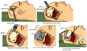 View of a craniotomy in which the skin is cut, and a rectangular opening is made in the bones of the skull through which the tumor is later operated on