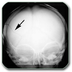 Image: X-ray of the skull - the arrow shows a fracture.