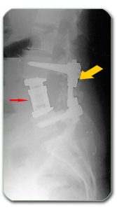 Figure: X-ray of the spine after removal of the vertebral body tumor (as in Figure B4)- the red arrow shows the prosthetic replacement for the removed vertebral body. The yellow arrow shows the posterior stabilization of the vertebra