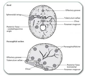 Picture: a large number of possible localizations of meningiomas. Depending on the localization, the patient has different symptoms and the type of operation differs.