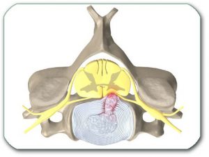 Figure: A cross section of the cervical vertebra and the disc between the 6th and 7th vertebrae. The disc has degenerated and its central part has partially "leaked" backward through the crack of the peripheral ring. That part of the disc puts pressure on the nerve roots and the spinal cord (yellow in color). This can lead to radiculopathy and myelopathy with disturbances in the sense of touch, as well as a decrease in muscle strength in all four extremities. The pain spreads to the neck, the shoulder, and along the arm with numbness of the fingers and weakness of the muscles of the hand. The function of ulnar nerve, which arises partly from the pinched nerve root in the picture, is most affected. Then the pinky and ring finger would tingle and experience weakness.