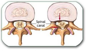 Stenosis due to bone spurs is more common in the cervical spine, and disc herniation in the lumbar spine. The thoracic spine is less frequently affected by these processes.