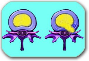 The figure shows cross-sections of 2 lumbar discs. On the left is a healthy disc with no changes in the central (yellow) part of the disc. On the right, there is a separation of the central part of the disc and its passage through the crack of the peripheral ring. The part of the disc that "leaked" backward exerts pressure on the nerve roots (pink). This leads to lumbosacral pain and disturbances in the sense of touch and to muscle weakness in part of the leg innervated by that nerve root.