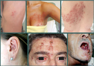 Image: different localizations of herpes zoster.  Even when the changes on the skin pass, the pain may remain.