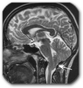 Figure: The arrow on the MR image of the brain shows the lowering of the lower parts of the cerebellum into the spinal canal, where they put pressure on the spinal cord and nerve roots