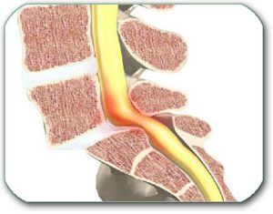 This picture shows the instability that is manifested by the sliding of the last lumbar vertebra forward (spondylolisthesis). If it causes problems, stabilization is indicated, as in the following figure.