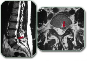 These images show magnetic resonance imaging of the lumbosacral spine - a sagittal-section on the left and a cross-section on the right. The red arrows indicate the part of the disc that leaked and puts pressure on the nerve roots.  Disc herniations are most common at the L4-L5 and L5-S1 levels.