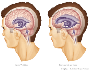 Picture: On the left is a view of a man with brain cavities (ventricles) of normal size, and on the right with dilated ventricles due to the hydrocephalus