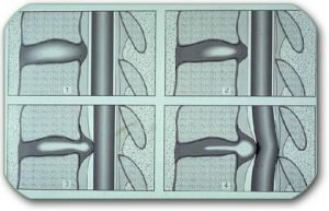 This picture shows a profile section of the thoracic spine and the progression of a disc herniation that puts more and more pressure on the spinal cord. The disc is in front, and the spinal cord is behind it.