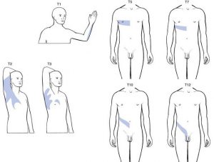 Locations of pain in intercostal neuralgia of different levels (Th1-TH12)