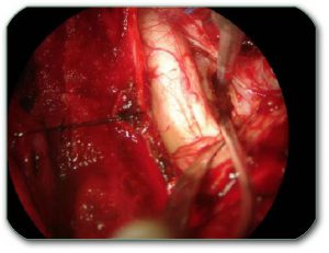 Image: Today, we can accurately and safely remove tumors under magnification of the surgical microscope by ultrasound aspirators (CUSA) even in the vicinity of such sensitive structures as the brain stem.