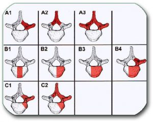 Figure: A1, A2, and A3 show various degrees of vertebral lamina removal (laminectomy); Figures B1, B2, B3, and B4 show the various degrees of vertebral body removal (corpectomy); Figures C1 and C2 are a combination of the previous two types of operations.